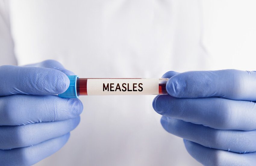  Колко са болните от морбили в България?